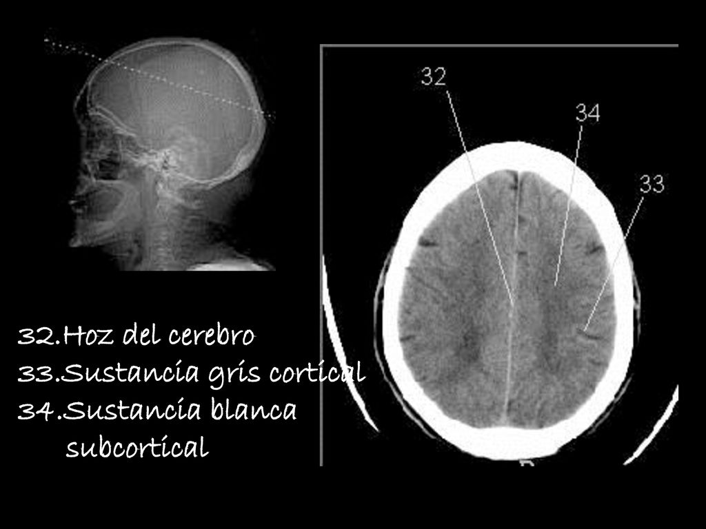 32.Hoz del cerebro 33.Sustancia gris cortical 34.Sustancia blanca subcortical