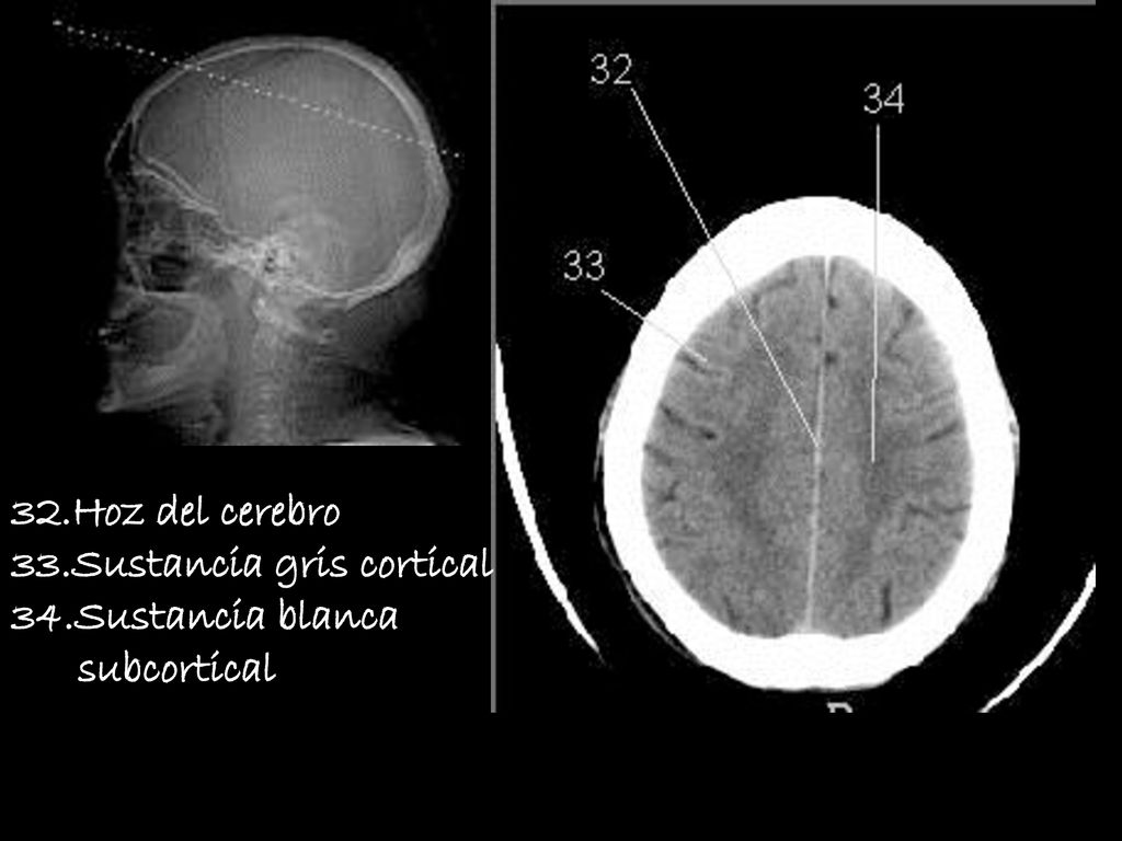 32.Hoz del cerebro 33.Sustancia gris cortical 34.Sustancia blanca subcortical