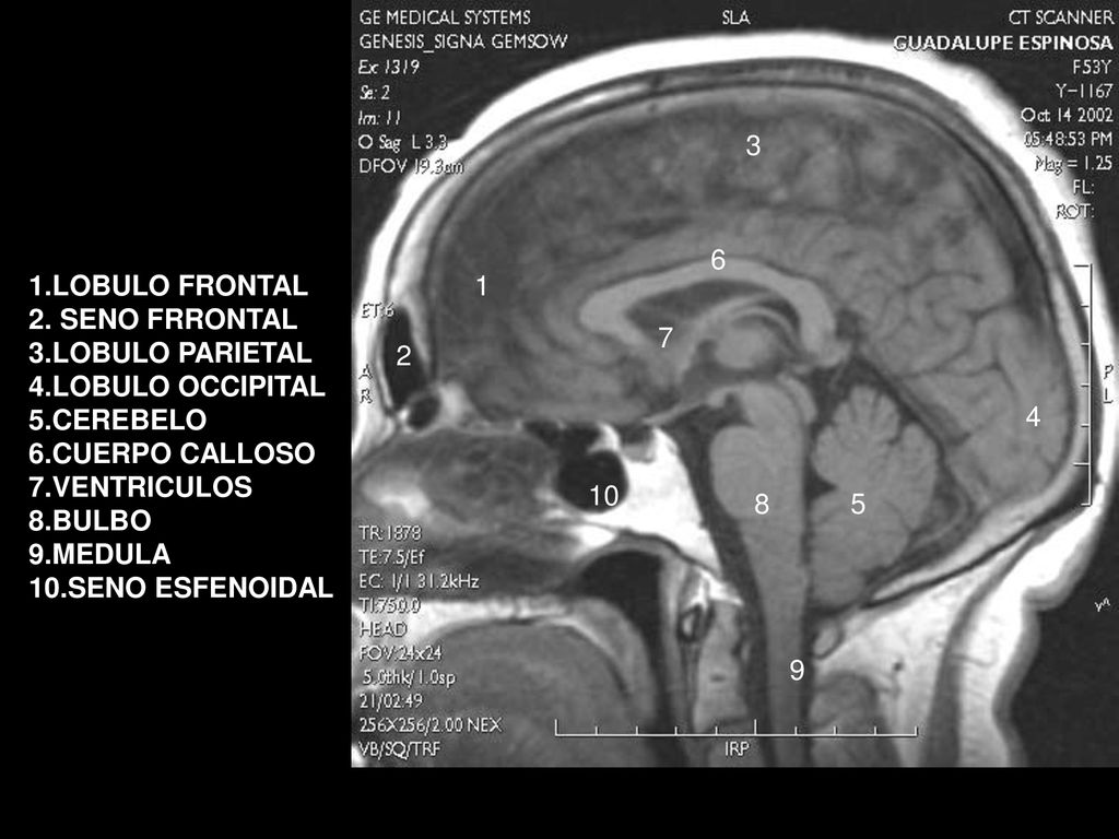 LOBULO FRONTAL. 2. SENO FRRONTAL. 3.LOBULO PARIETAL. 4.LOBULO OCCIPITAL. 5.CEREBELO. 6.CUERPO CALLOSO.