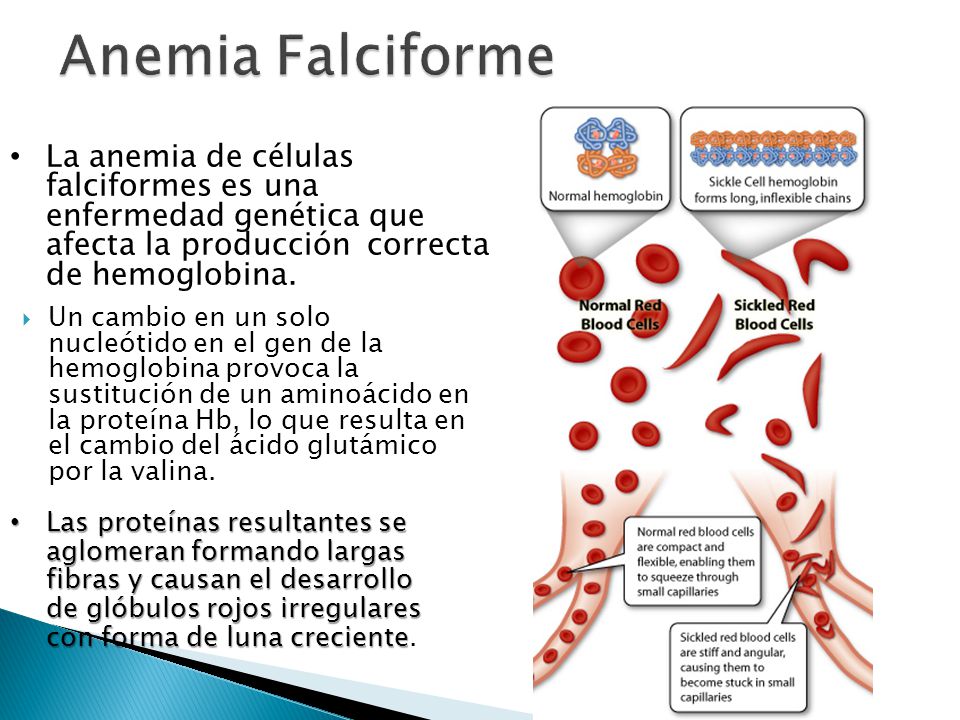 Anemia Falciforme La anemia de células falciformes es una enfermedad genética que afecta la producción correcta de hemoglobina.