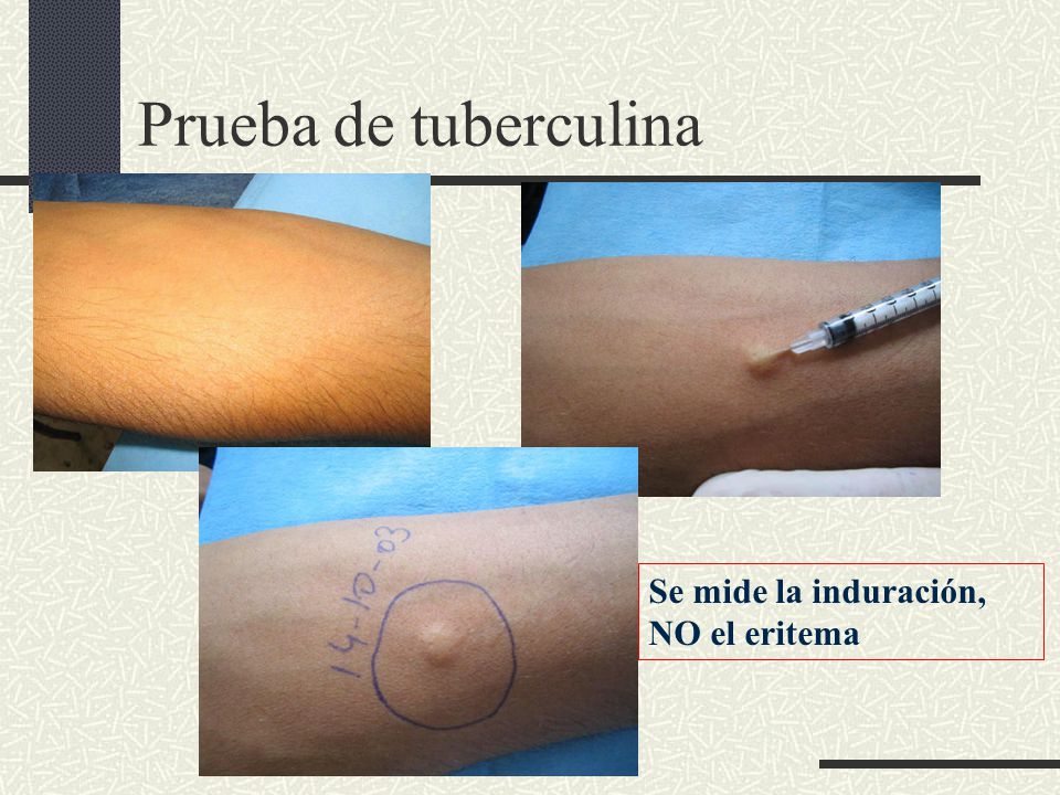 Prueba de tuberculina Se mide la induración, NO el eritema