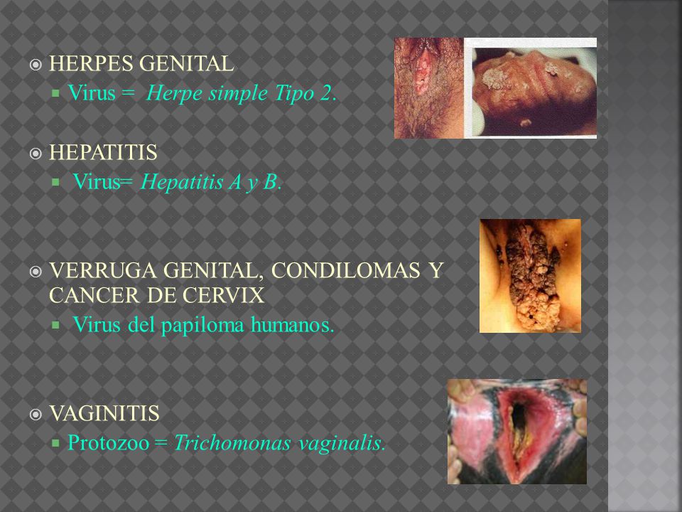 HERPES GENITAL Virus = Herpe simple Tipo 2. HEPATITIS. Virus= Hepatitis A y B. VERRUGA GENITAL, CONDILOMAS Y CANCER DE CERVIX.