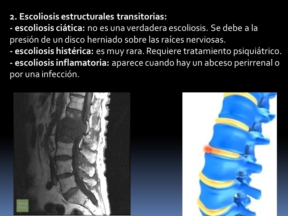 2. Escoliosis estructurales transitorias: - escoliosis ciática: no es una verdadera escoliosis.