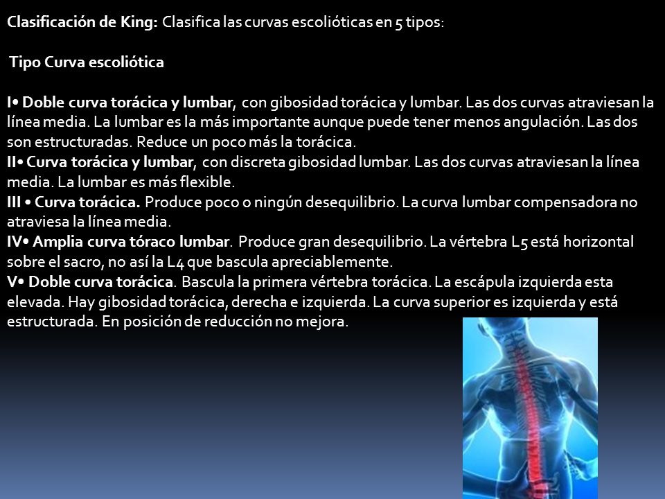 Clasificación de King: Clasifica las curvas escolióticas en 5 tipos: