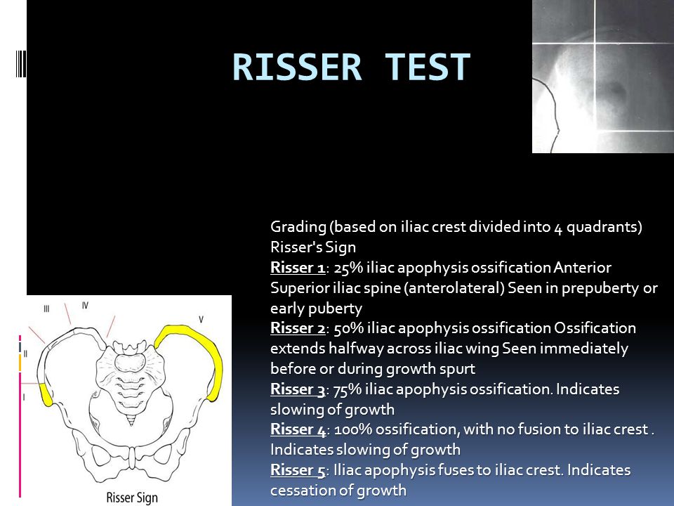 RISSER TEST Grading (based on iliac crest divided into 4 quadrants)