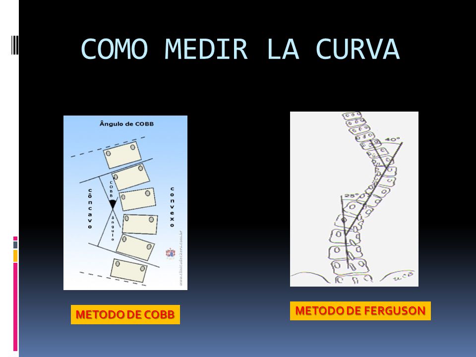 COMO MEDIR LA CURVA METODO DE FERGUSON METODO DE COBB