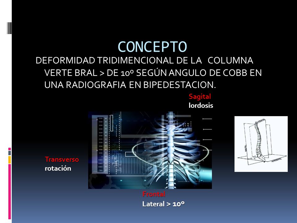 DEFORMIDAD TRIDIMENCIONAL DE LA COLUMNA VERTE BRAL > DE 10º SEGÚN ANGULO DE COBB EN UNA RADIOGRAFIA EN BIPEDESTACION.