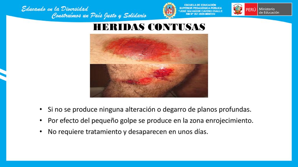 HERIDAS CONTUSAS Si no se produce ninguna alteración o degarro de planos profundas.