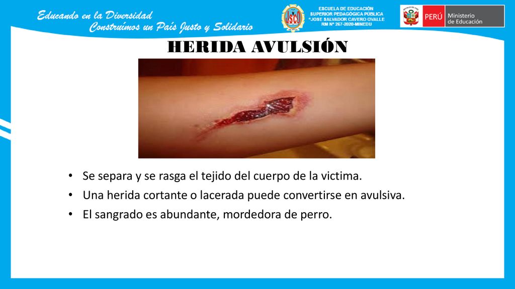 HERIDA AVULSIÓN Se separa y se rasga el tejido del cuerpo de la victima. Una herida cortante o lacerada puede convertirse en avulsiva.