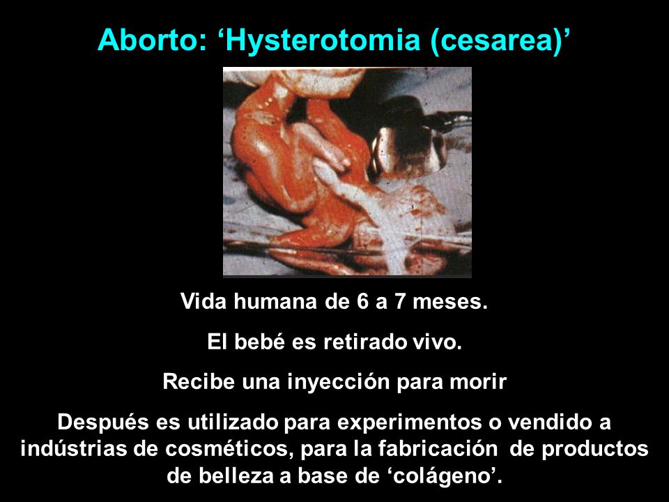 Aborto: ‘Hysterotomia (cesarea)’
