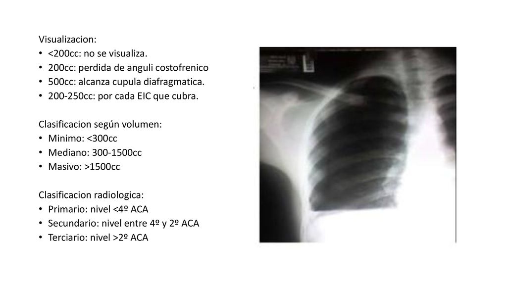 Visualizacion: <200cc: no se visualiza. 200cc: perdida de anguli costofrenico. 500cc: alcanza cupula diafragmatica.