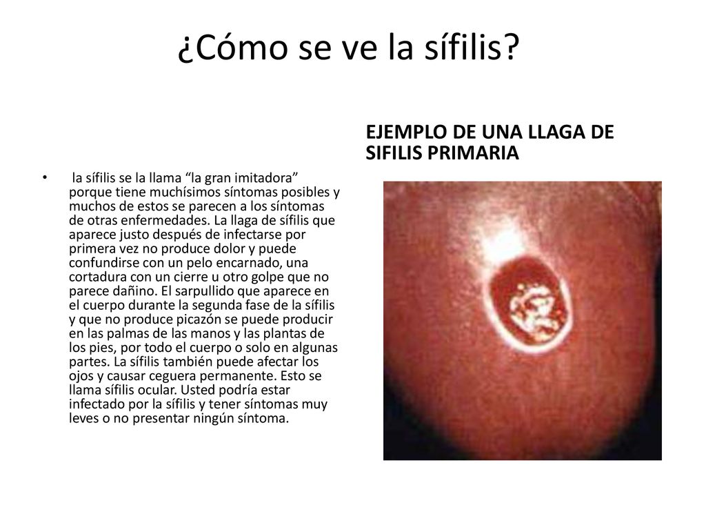 ¿Cómo se ve la sífilis EJEMPLO DE UNA LLAGA DE SIFILIS PRIMARIA