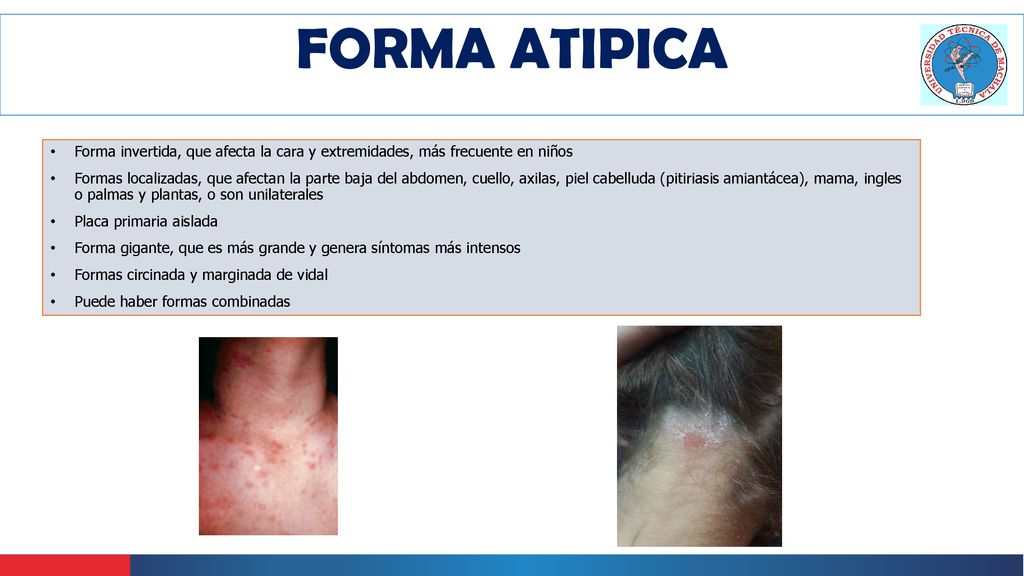 FORMA ATIPICA Forma invertida, que afecta la cara y extremidades, más frecuente en niños.