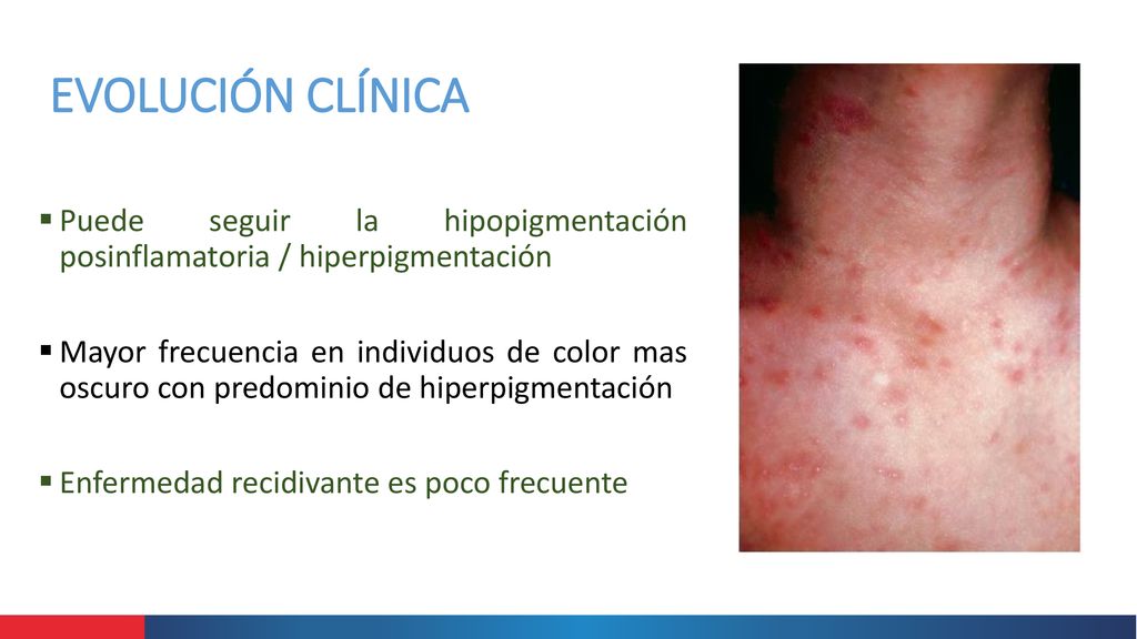 EVOLUCIÓN CLÍNICA Puede seguir la hipopigmentación posinflamatoria / hiperpigmentación.