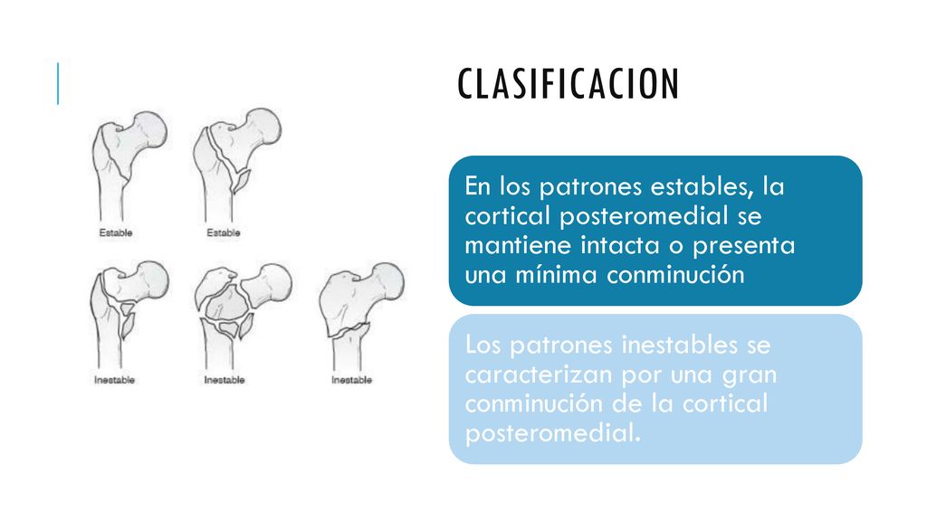 CLASIFICACION En los patrones estables, la cortical posteromedial se mantiene intacta o presenta una mínima conminución.
