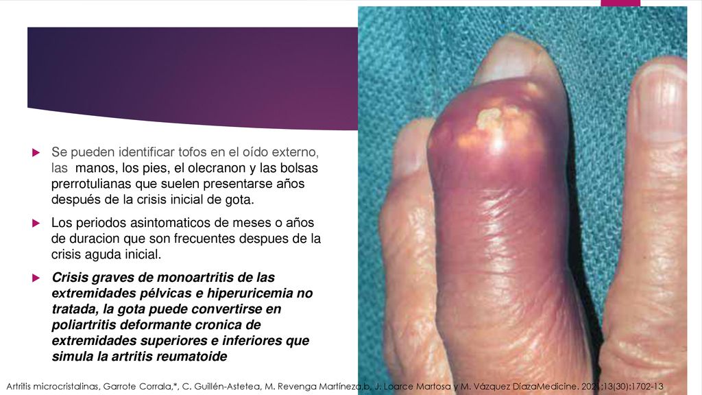 Se pueden identificar tofos en el oído externo, las manos, los pies, el olecranon y las bolsas prerrotulianas que suelen presentarse años después de la crisis inicial de gota.