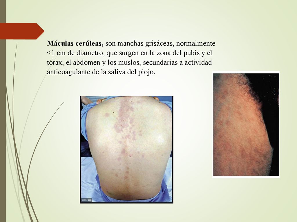 Máculas cerúleas, son manchas grisáceas, normalmente <1 cm de diámetro, que surgen en la zona del pubis y el tórax, el abdomen y los muslos, secundarias a actividad anticoagulante de la saliva del piojo.