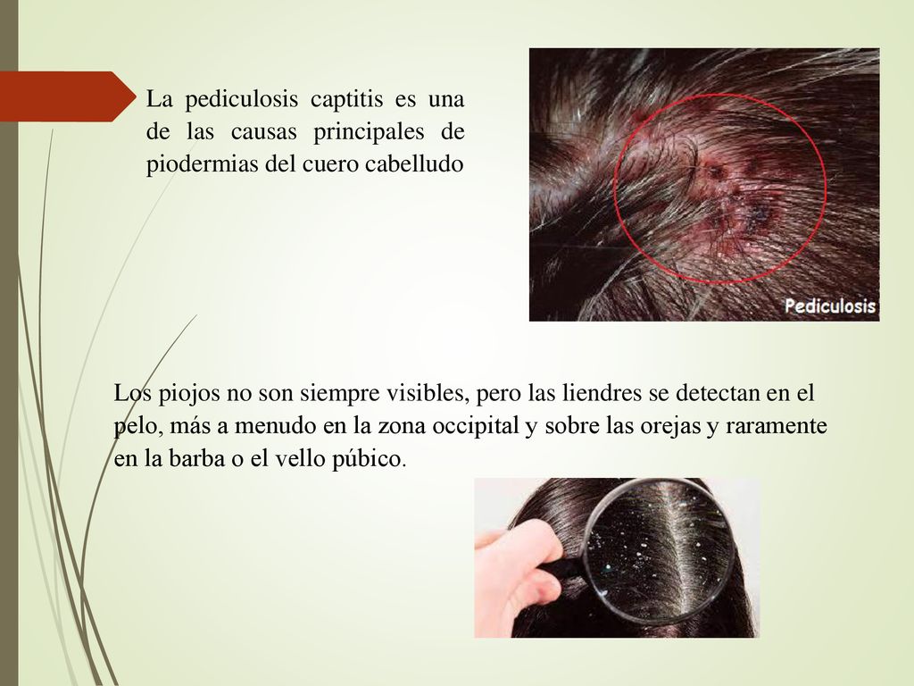 La pediculosis captitis es una de las causas principales de piodermias del cuero cabelludo