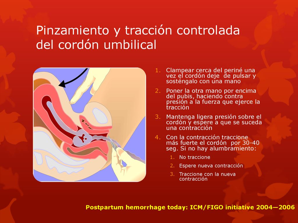 Pinzamiento y tracción controlada del cordón umbilical
