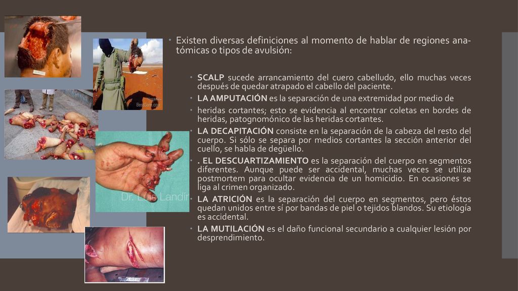 Existen diversas definiciones al momento de hablar de regiones ana- tómicas o tipos de avulsión: