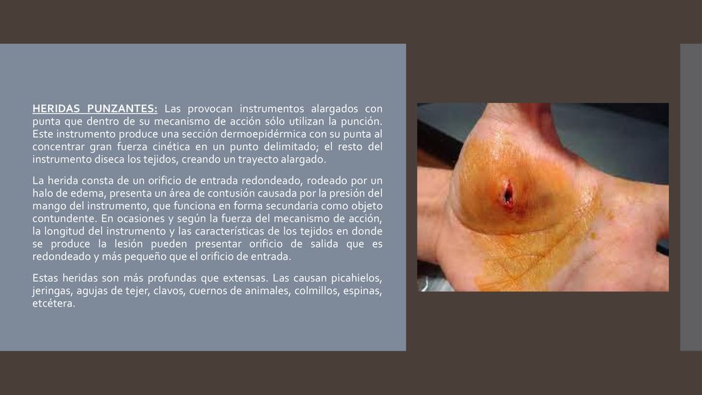 HERIDAS PUNZANTES: Las provocan instrumentos alargados con punta que dentro de su mecanismo de acción sólo utilizan la punción. Este instrumento produce una sección dermoepidérmica con su punta al concentrar gran fuerza cinética en un punto delimitado; el resto del instrumento diseca los tejidos, creando un trayecto alargado.