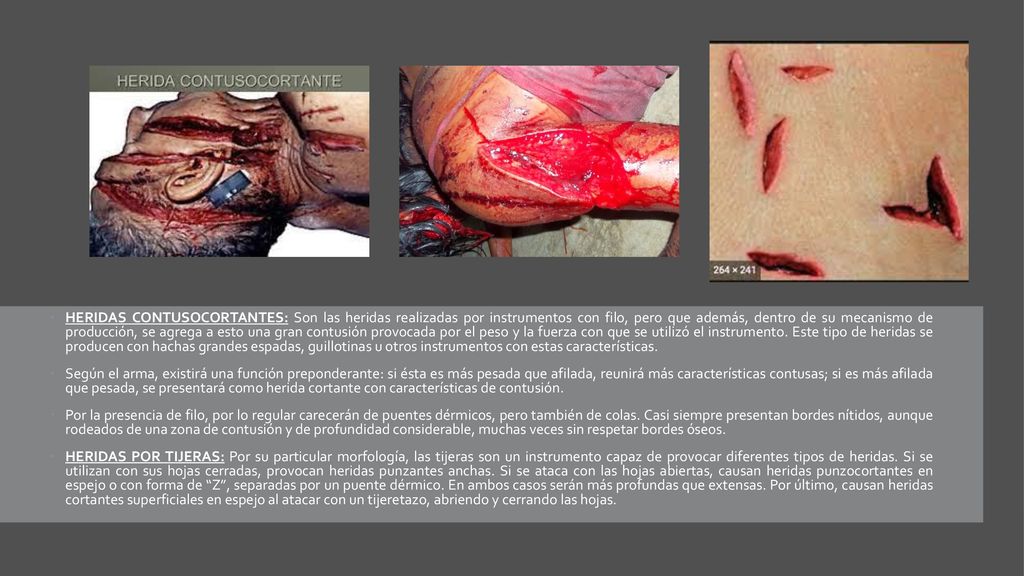 HERIDAS CONTUSOCORTANTES: Son las heridas realizadas por instrumentos con filo, pero que además, dentro de su mecanismo de producción, se agrega a esto una gran contusión provocada por el peso y la fuerza con que se utilizó el instrumento. Este tipo de heridas se producen con hachas grandes espadas, guillotinas u otros instrumentos con estas características.