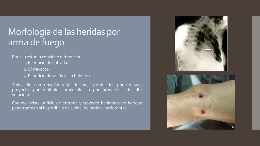 Morfología de las heridas por arma de fuego
