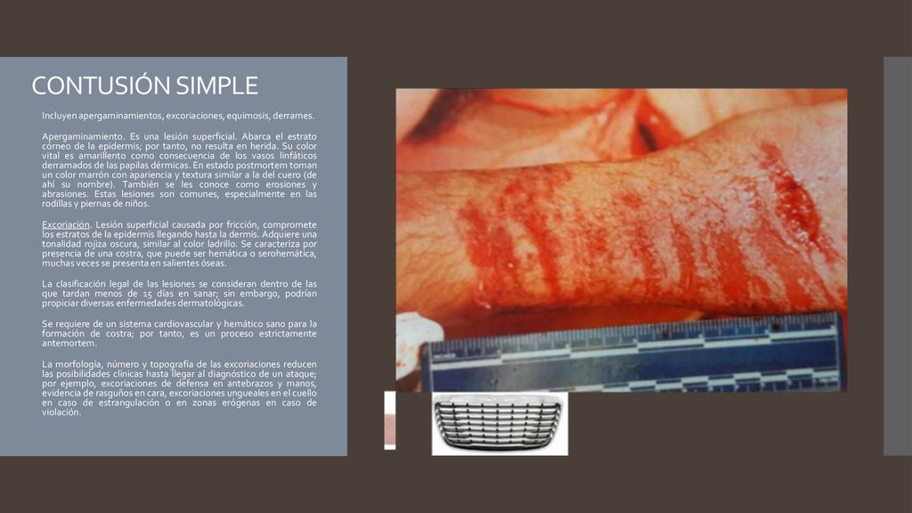 CONTUSIÓN SIMPLE Incluyen apergaminamientos, excoriaciones, equimosis, derrames.
