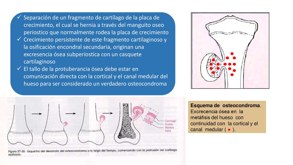 Separación de un fragmento de cartílago de la placa de crecimiento, el cual se hernia a través del manguito oseo periostico que normalmente rodea la placa de crecimiento