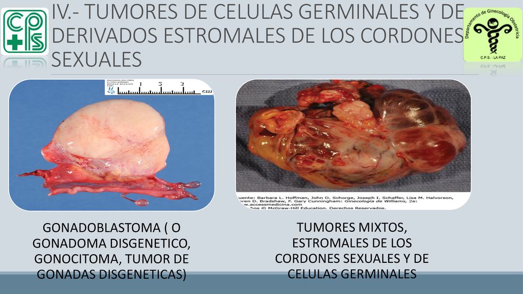 IV.- TUMORES DE CELULAS GERMINALES Y DE DERIVADOS ESTROMALES DE LOS CORDONES SEXUALES