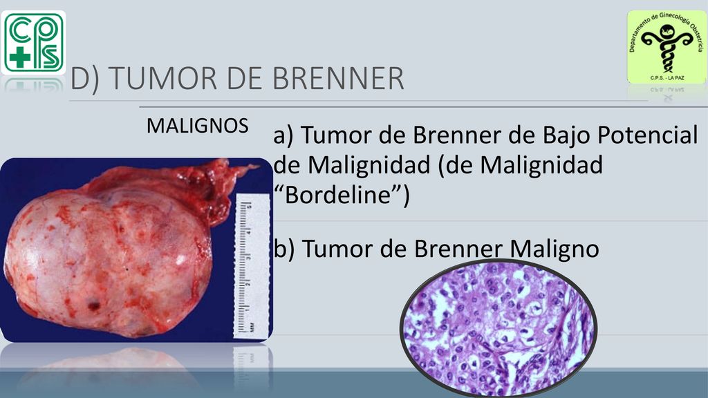 D) TUMOR DE BRENNER MALIGNOS. a) Tumor de Brenner de Bajo Potencial de Malignidad (de Malignidad Bordeline )