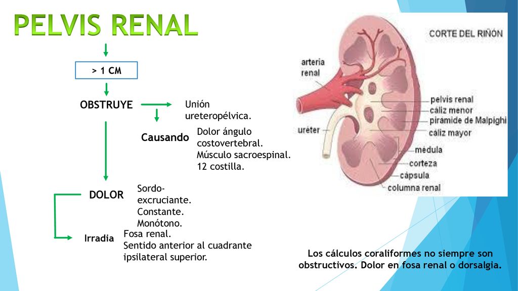 PELVIS RENAL OBSTRUYE Causando DOLOR > 1 CM Unión ureteropélvica.