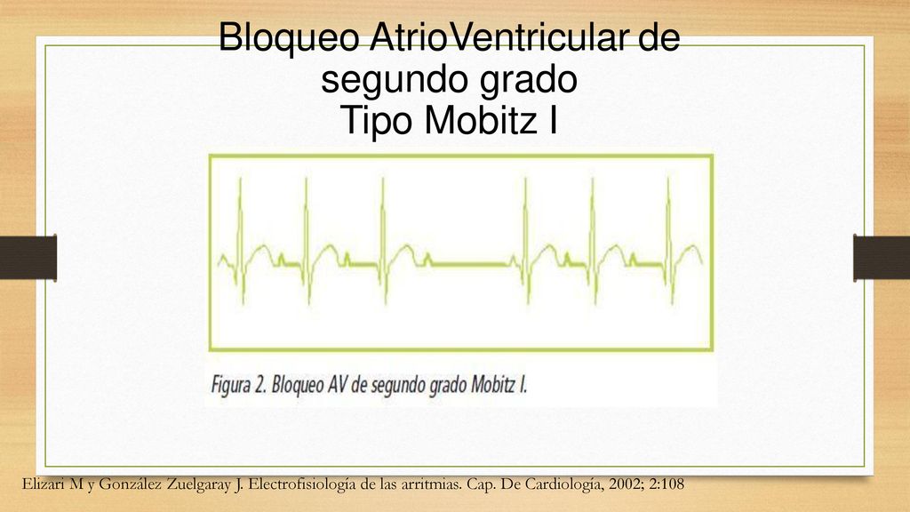 Bloqueo AtrioVentricular de segundo grado Tipo Mobitz I