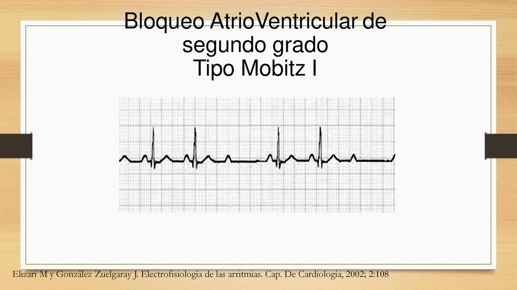 Bloqueo AtrioVentricular de segundo grado Tipo Mobitz I