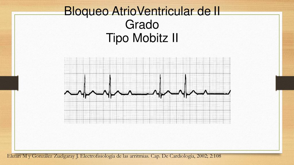 Bloqueo AtrioVentricular de II Grado Tipo Mobitz II
