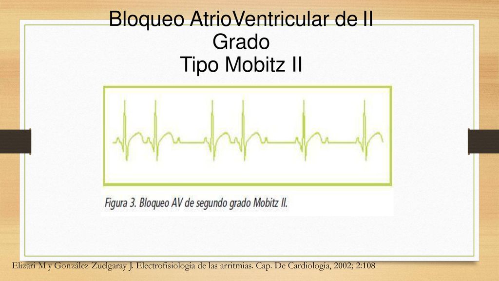 Bloqueo AtrioVentricular de II Grado Tipo Mobitz II