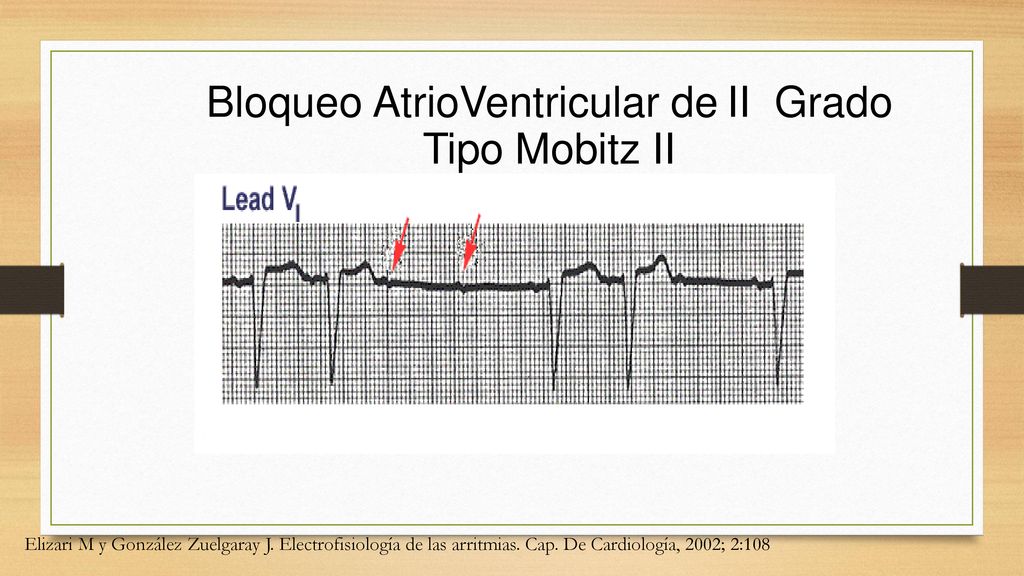 Bloqueo AtrioVentricular de II Grado Tipo Mobitz II