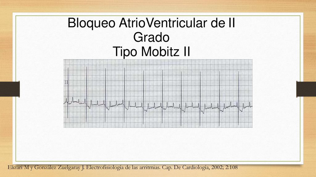 Bloqueo AtrioVentricular de II Grado Tipo Mobitz II