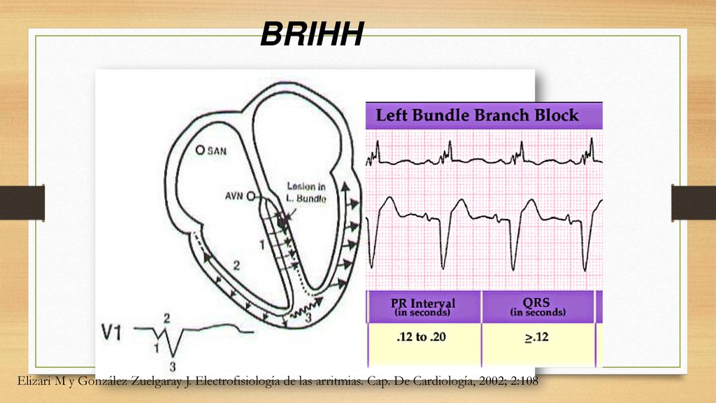 BRIHH Elizari M y González Zuelgaray J. Electrofisiología de las arritmias.