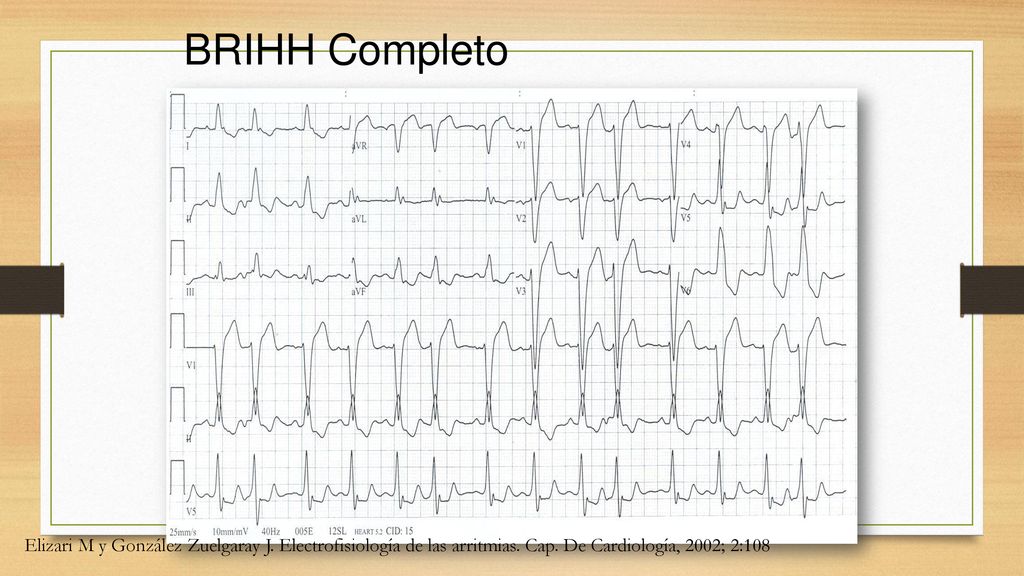 BRIHH Completo Elizari M y González Zuelgaray J. Electrofisiología de las arritmias.