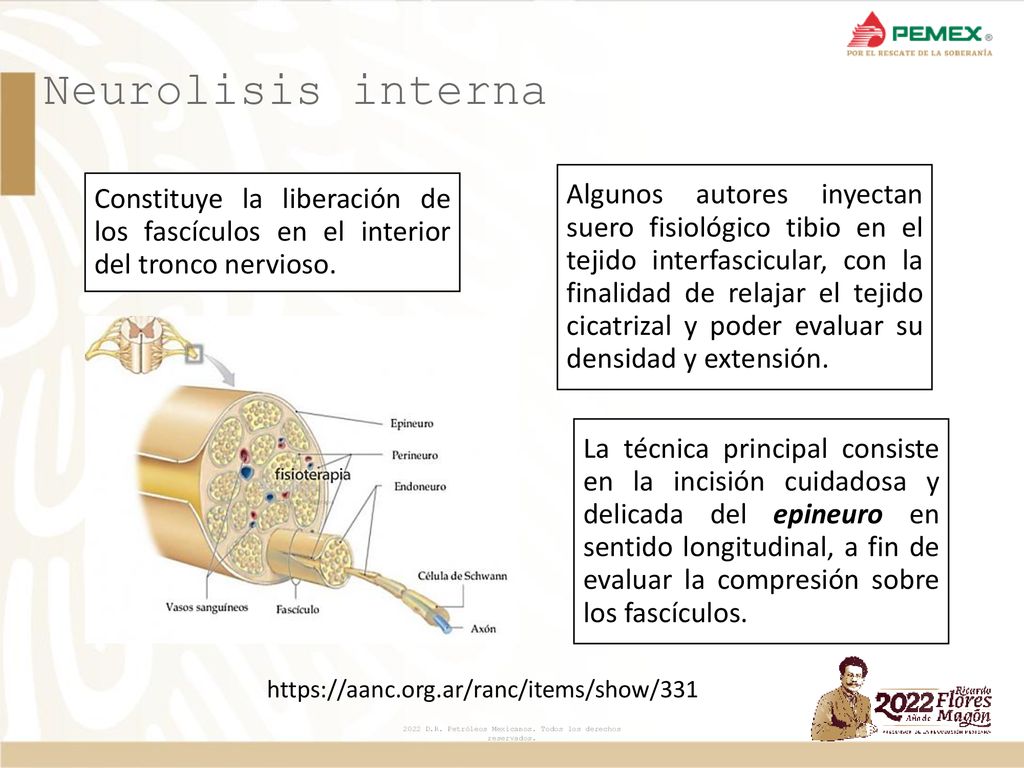 Neurolisis interna Constituye la liberación de los fascículos en el interior del tronco nervioso.