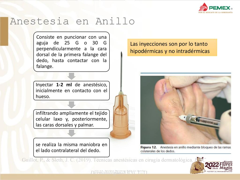 Anestesia en Anillo Las inyecciones son por lo tanto
