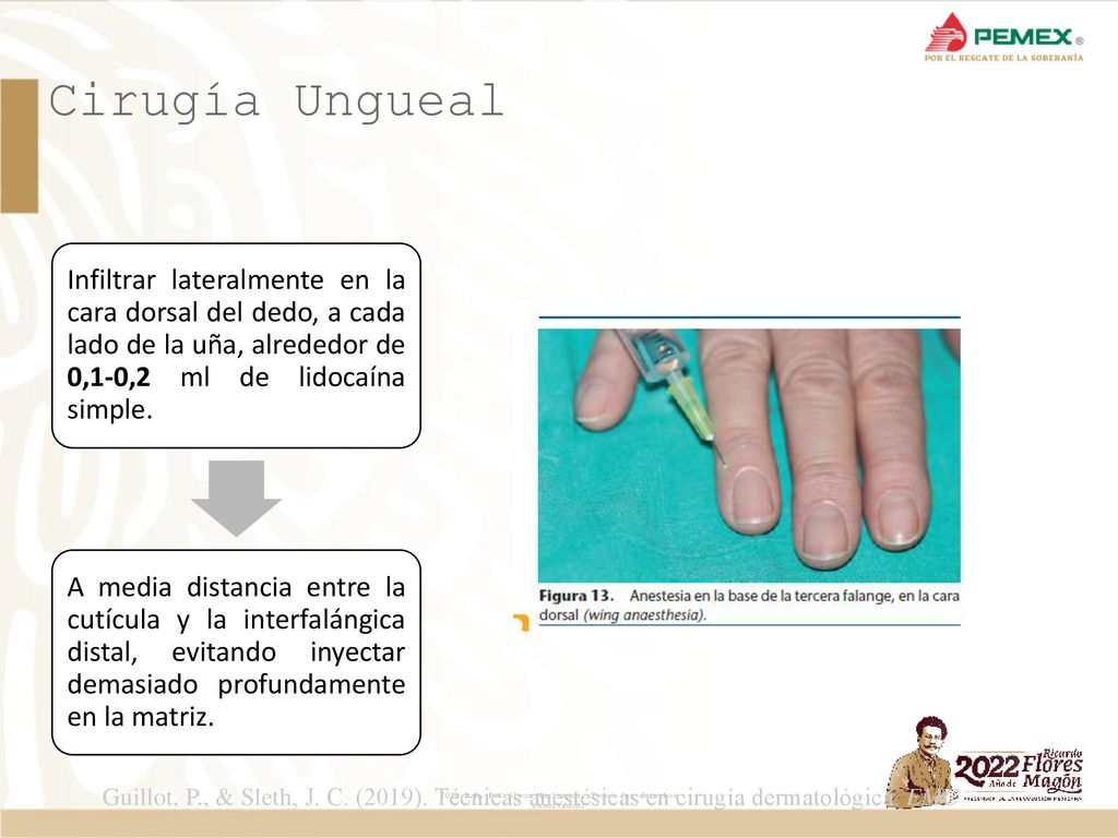 Cirugía Ungueal Infiltrar lateralmente en la cara dorsal del dedo, a cada lado de la uña, alrededor de 0,1-0,2 ml de lidocaína simple.