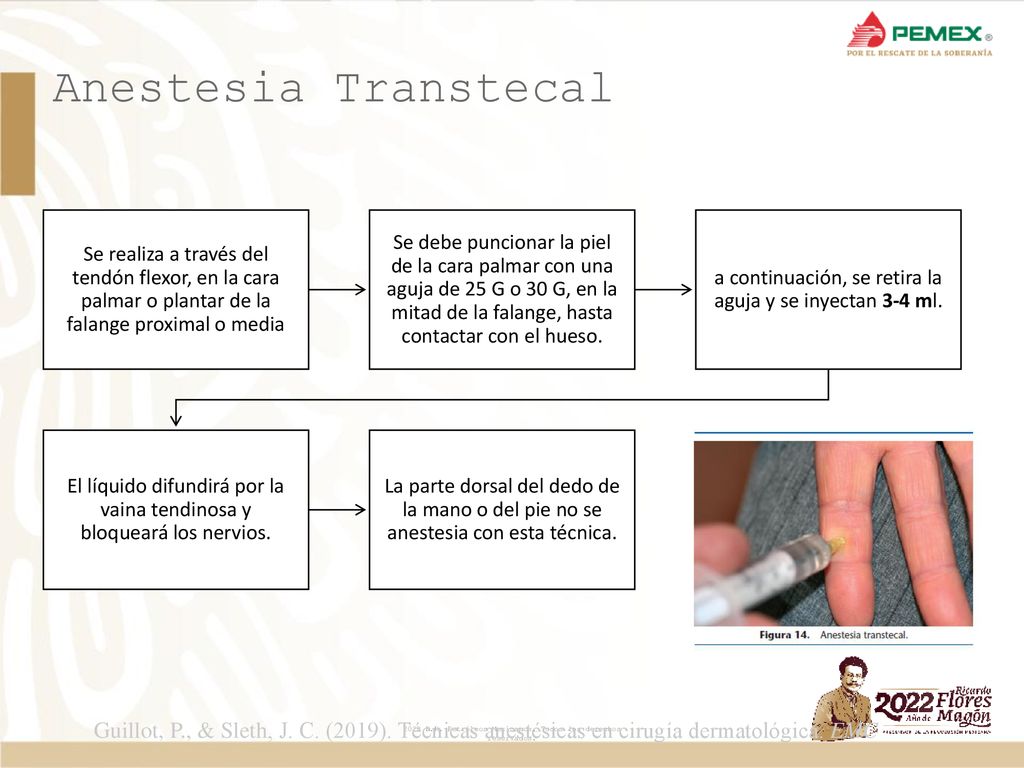 Anestesia Transtecal Se realiza a través del tendón flexor, en la cara palmar o plantar de la falange proximal o media.