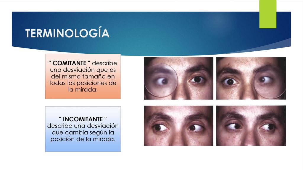 TERMINOLOGÍA COMITANTE describe una desviación que es del mismo tamaño en todas las posiciones de la mirada.