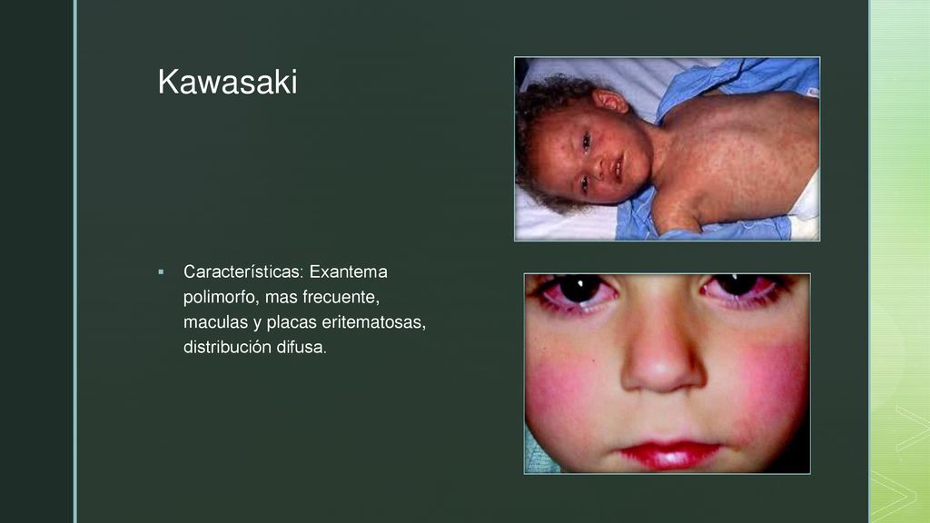 Kawasaki Características: Exantema polimorfo, mas frecuente, maculas y placas eritematosas, distribución difusa.
