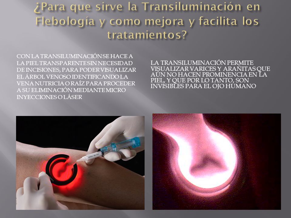 ¿Para que sirve la Transiluminación en Flebología y como mejora y facilita los tratamientos