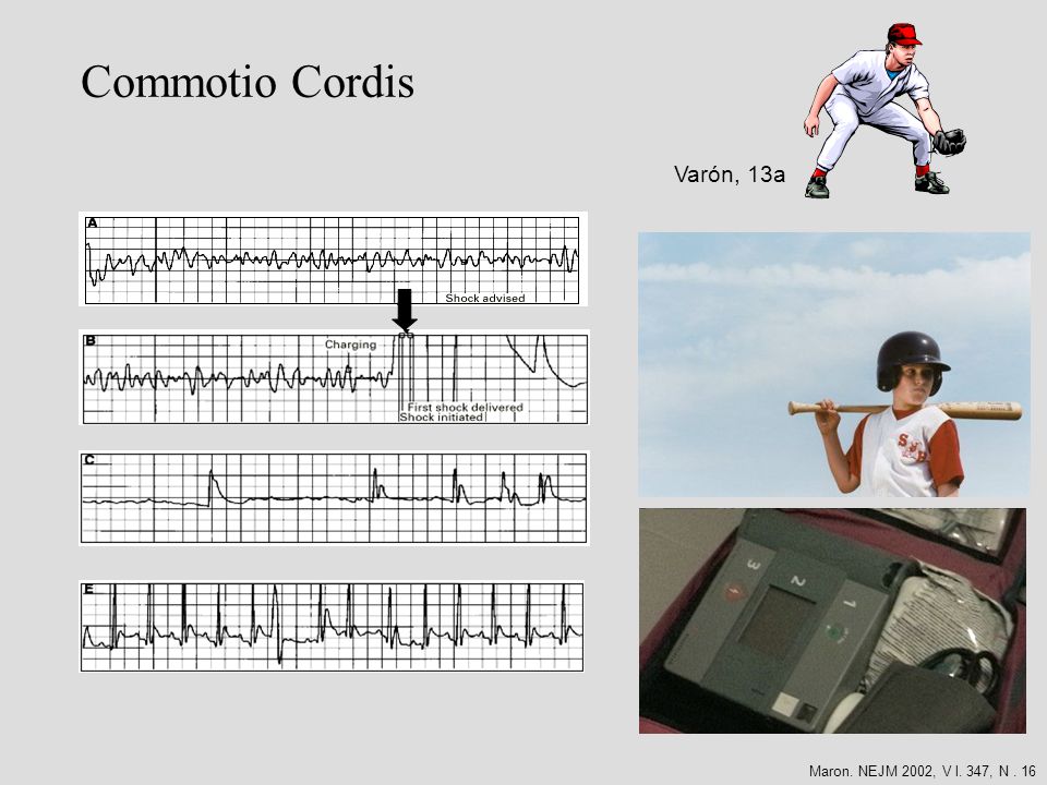 Commotio Cordis Varón, 13a Maron. NEJM 2002, V l. 347, N . 16
