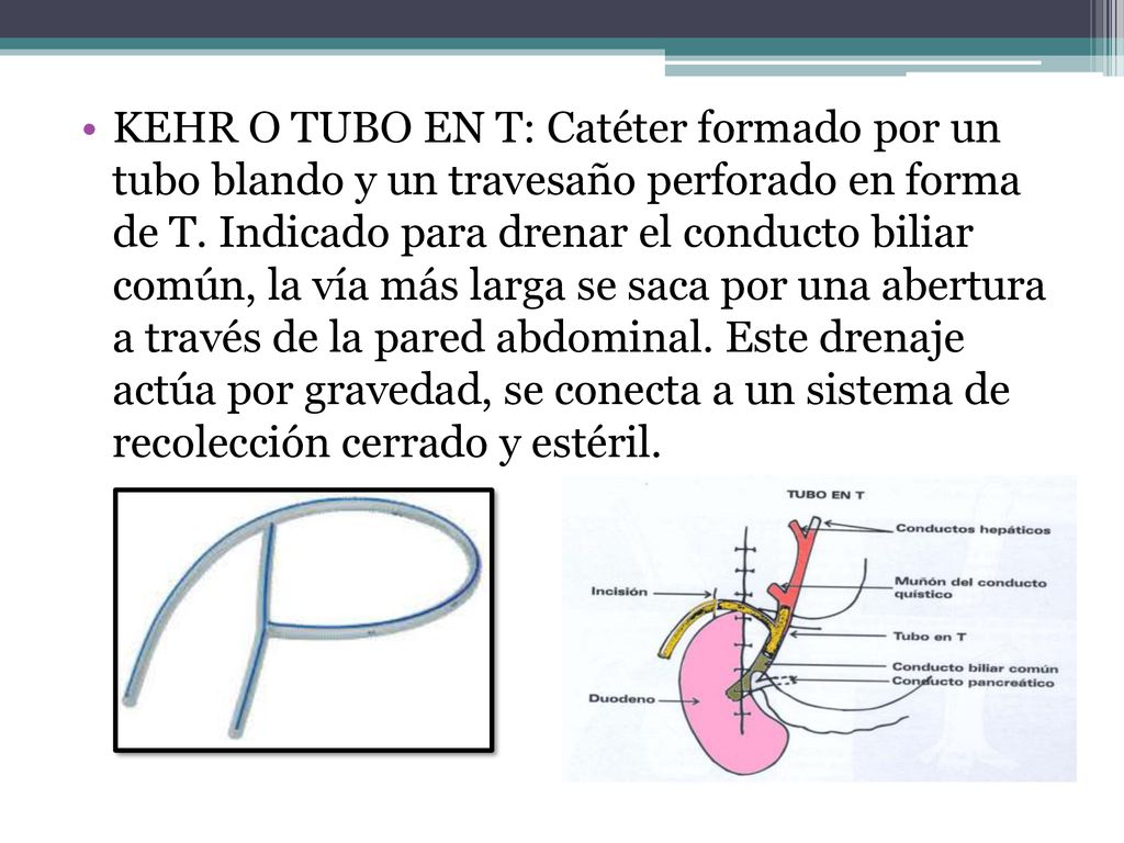 KEHR O TUBO EN T: Catéter formado por un tubo blando y un travesaño perforado en forma de T.