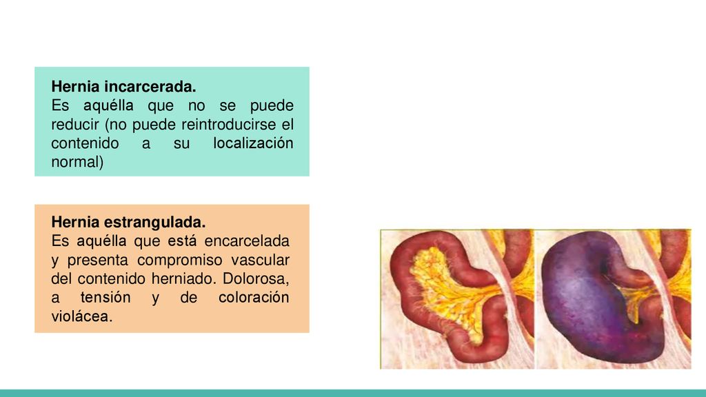 Hernia incarcerada. Es aquélla que no se puede reducir (no puede reintroducirse el contenido a su localización normal)
